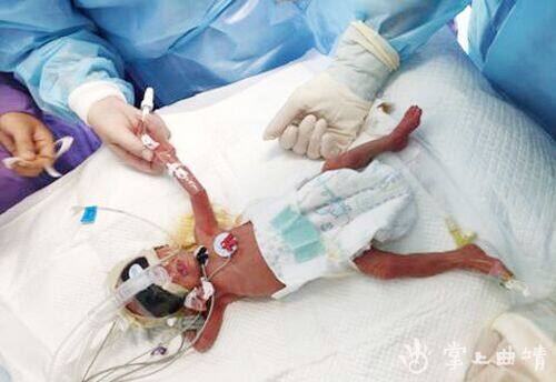 点赞!曲靖市二院成功救治30周早产巴掌婴儿